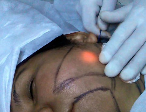 liposucción-láser-de-mejillas