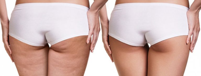 Celulitis en Lima - Lasthetic