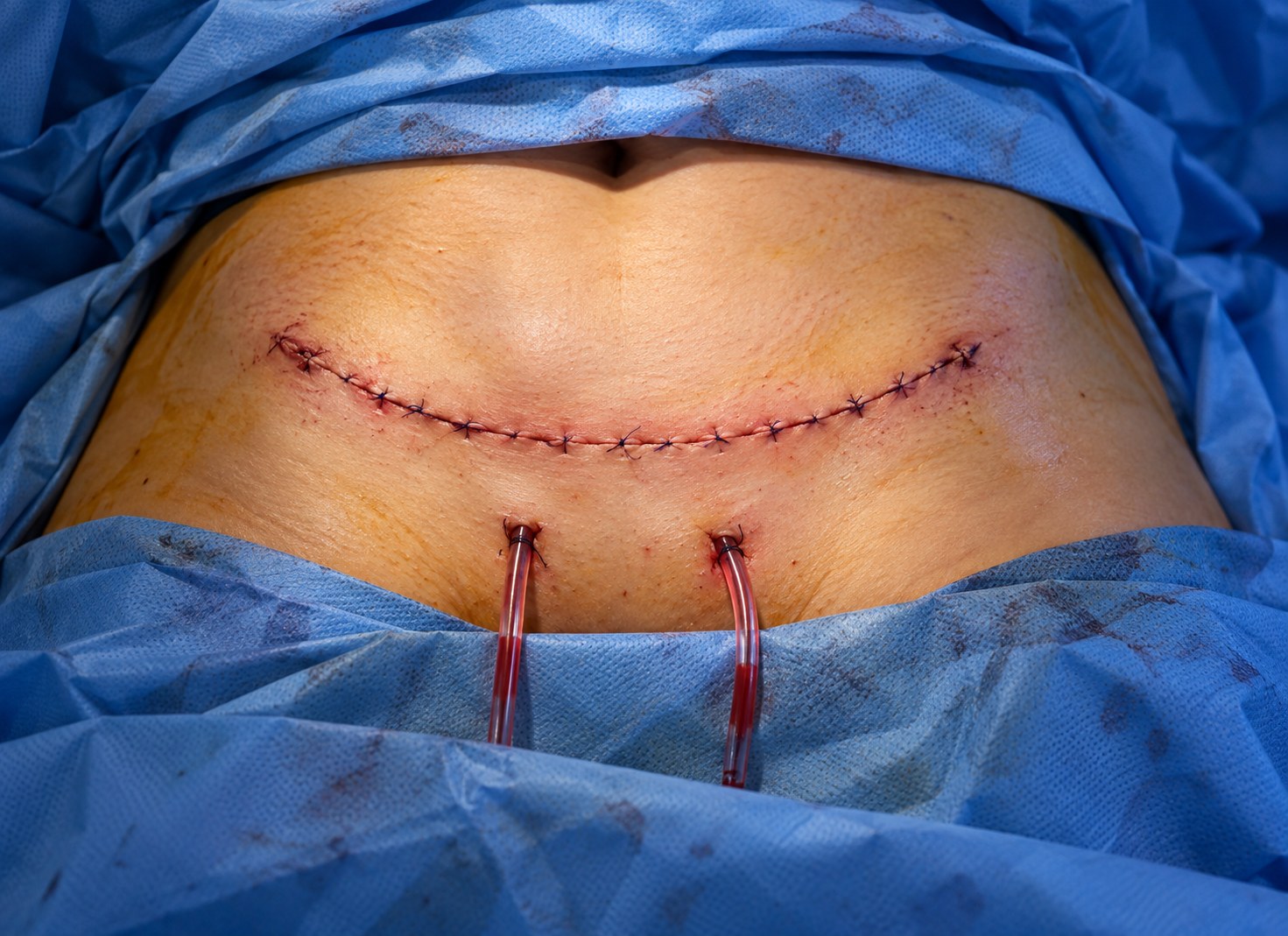 Abdominoplastia (abdomen plano) en Lima - Lasthetic