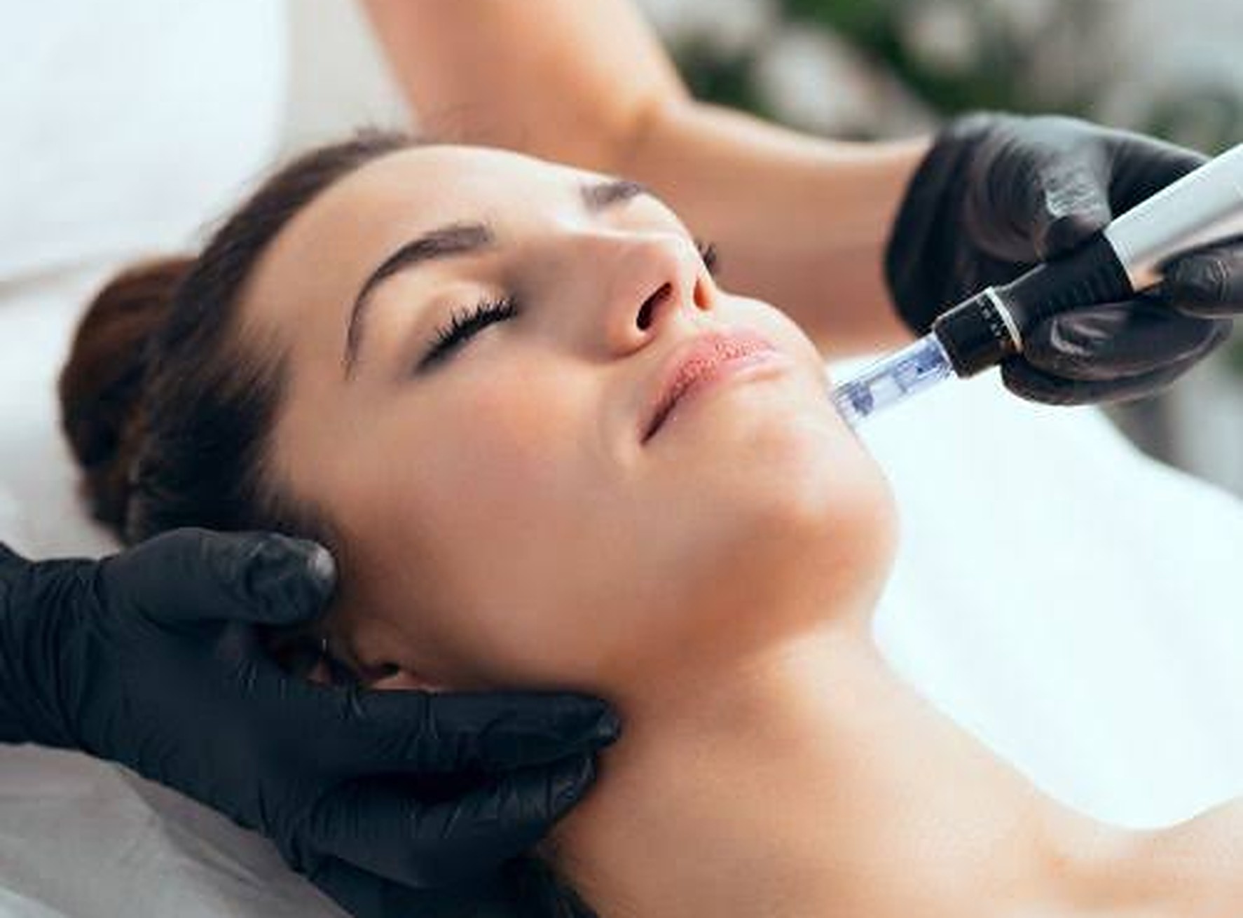 Dermapen (sistema de agujas) en Lima - Lasthetic